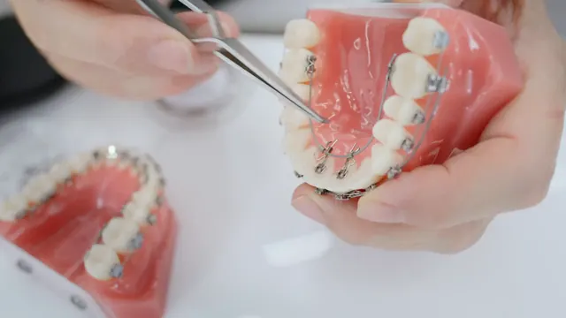 Mani coi guanti posano con la pinzetta un attacco sul modello di un'arcata, con l'apparecchio fisso sul lato interno dei denti